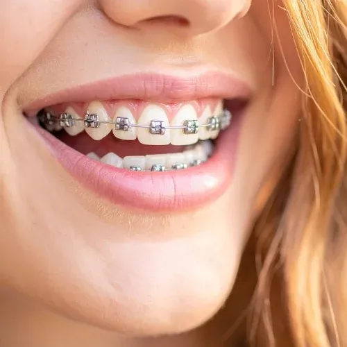 Traditional Braces