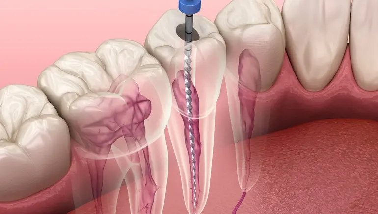 Can a dentist remove a root canal tooth