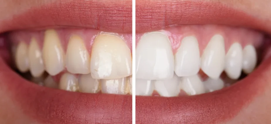 Teeth Cleaning and whitening Teeth Cleaning and whitening